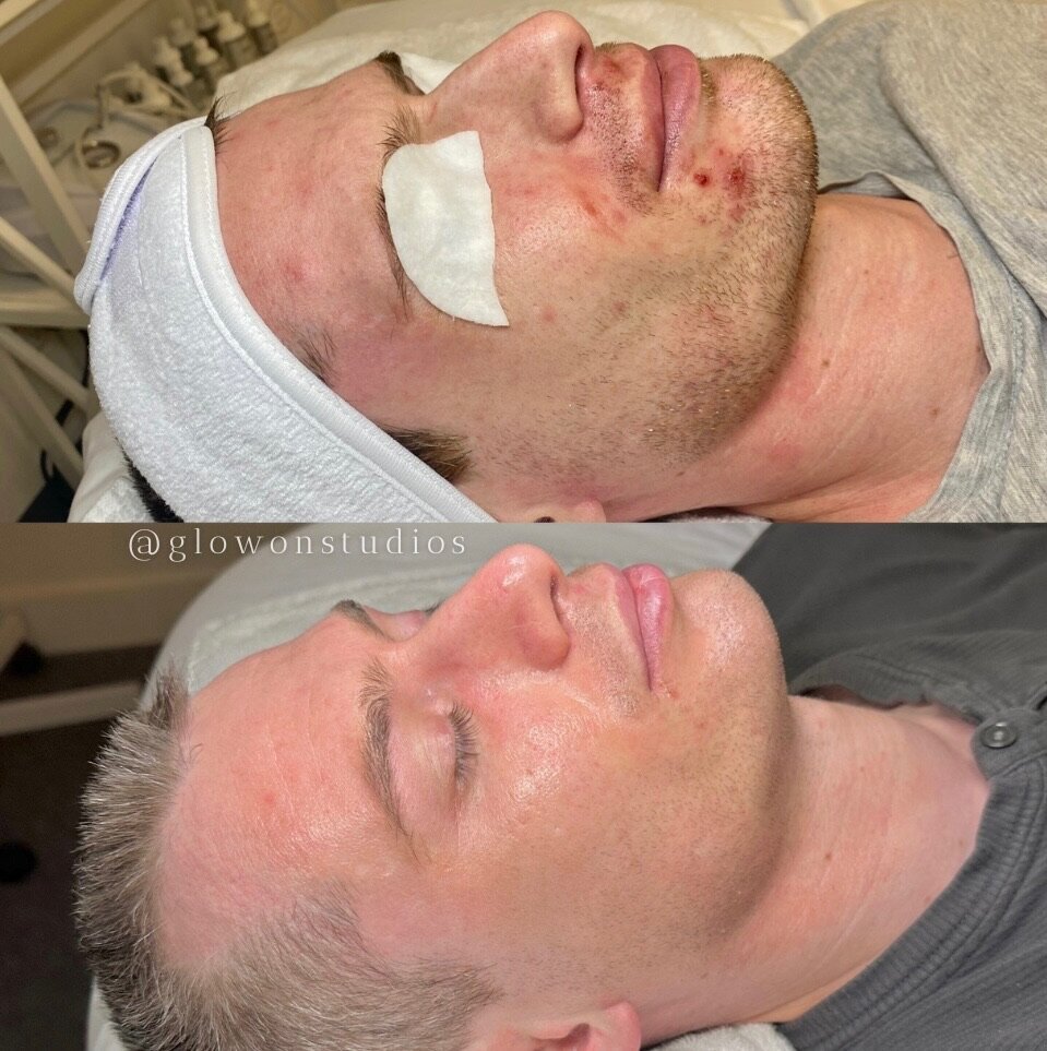 Glow-On-Studios-Before-After-Skincare-Sacramento-12