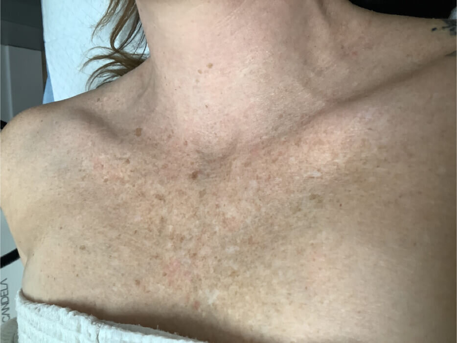 before ipl chest