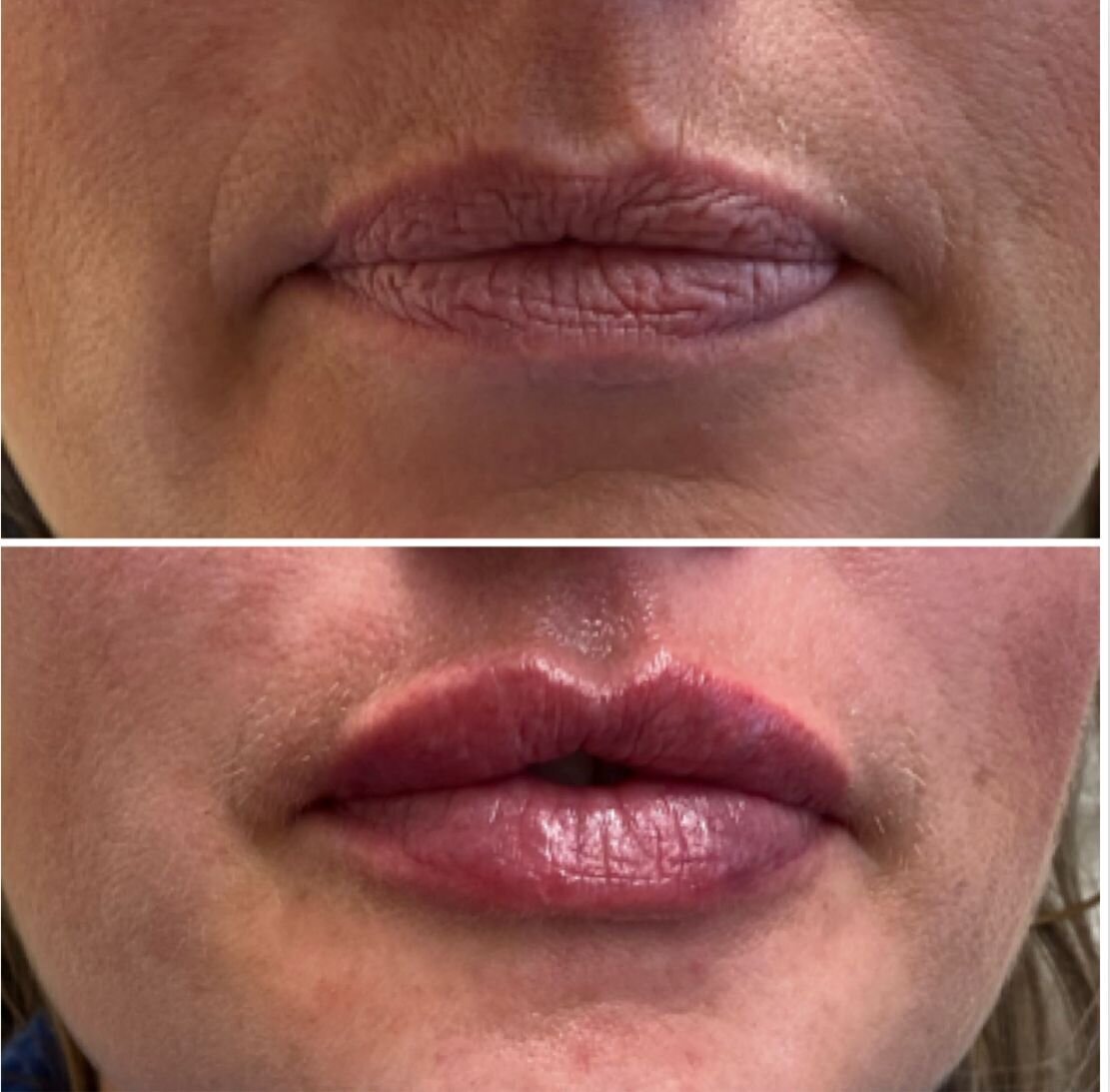 compressed-Lip-Wrinkles- Lip-volume-nd-some-brand-pics-03