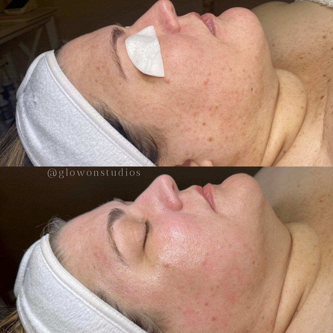Glow-On-Studios-Before-After-Skincare-Sacramento-15