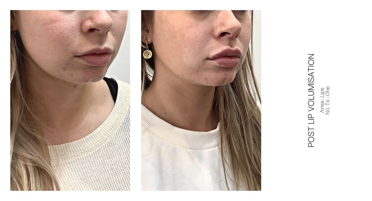 Best South Coast Lip Injection Before and After 4