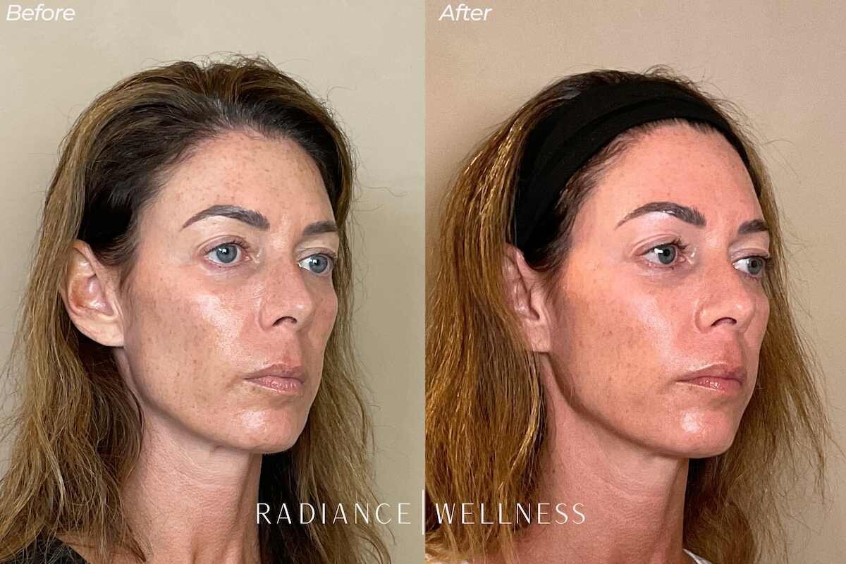 Sculptra-bna-nov13-1