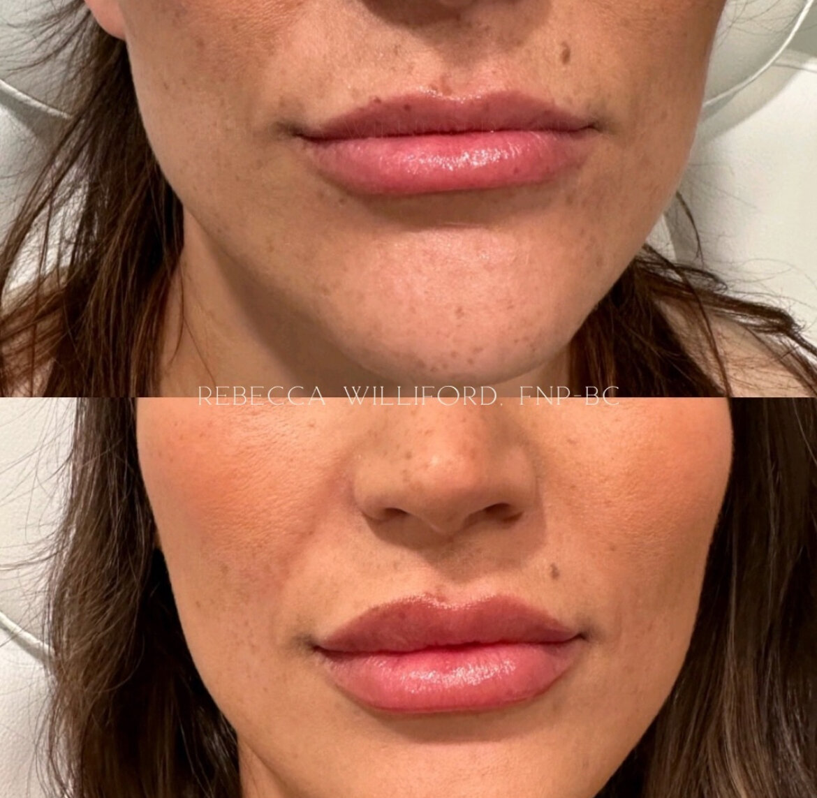 Lip Filler by Rebecca Williford at The Rae Clinic in Augusta, Georgia