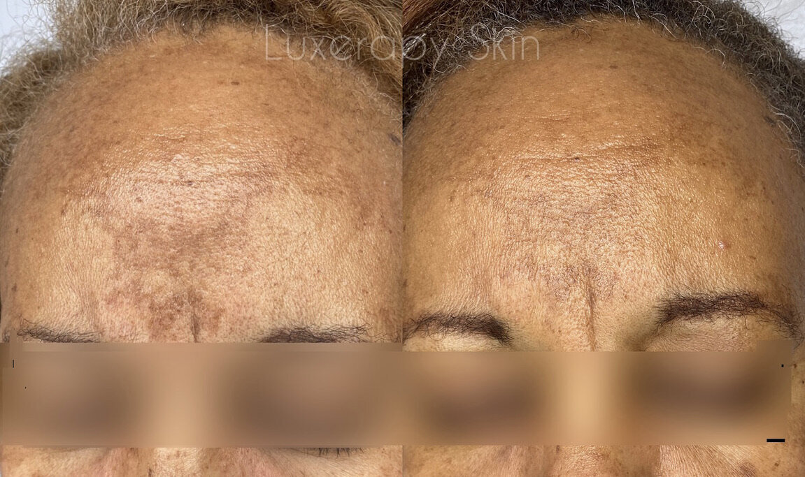 melasma treatment - before and after
