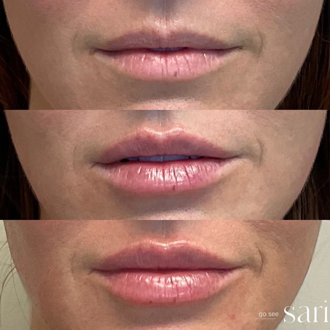 Lip Filler Progression_Go See Sari