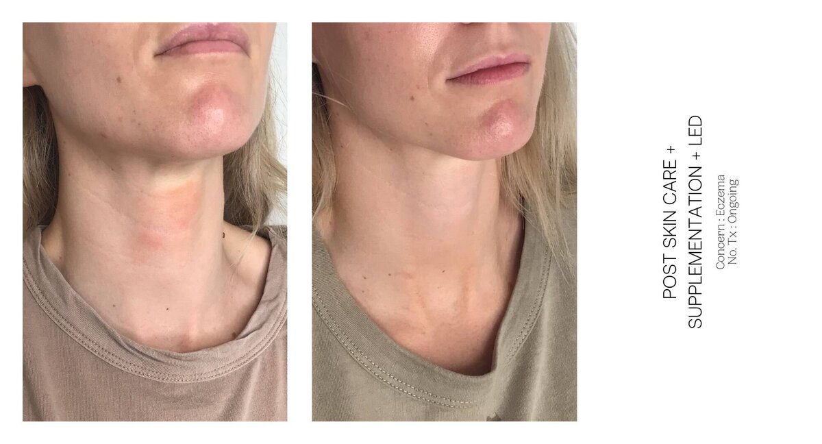 Eczema Before and After 1