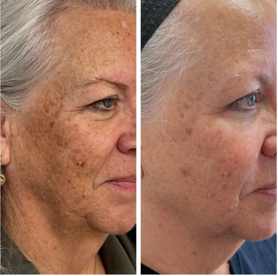 bbl-before-after-07