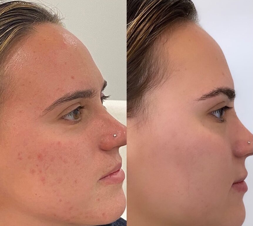 Microneedling before and after 2