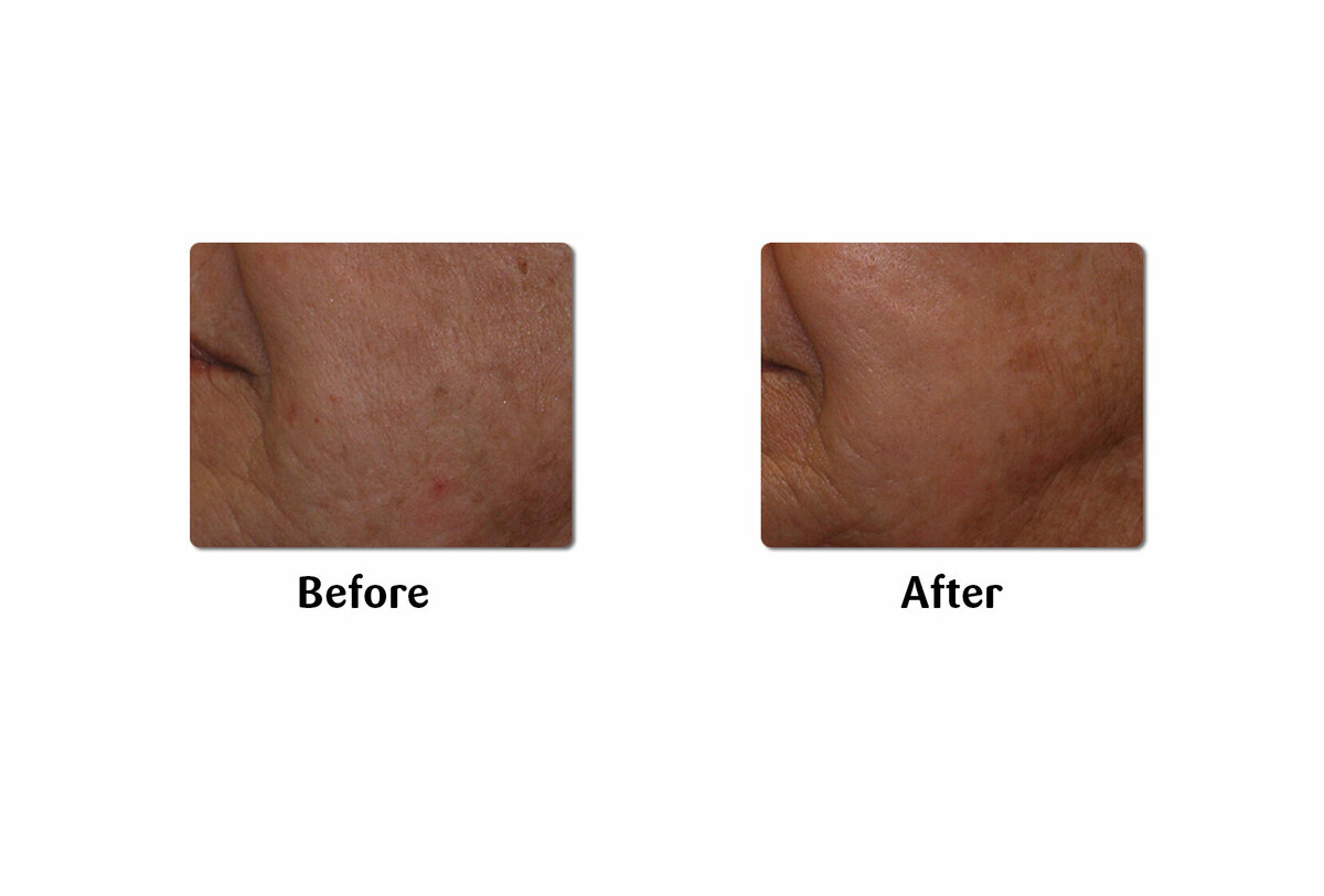 Li Medical Aesthetics Skin Tightening with VST Sinclair Before and After5