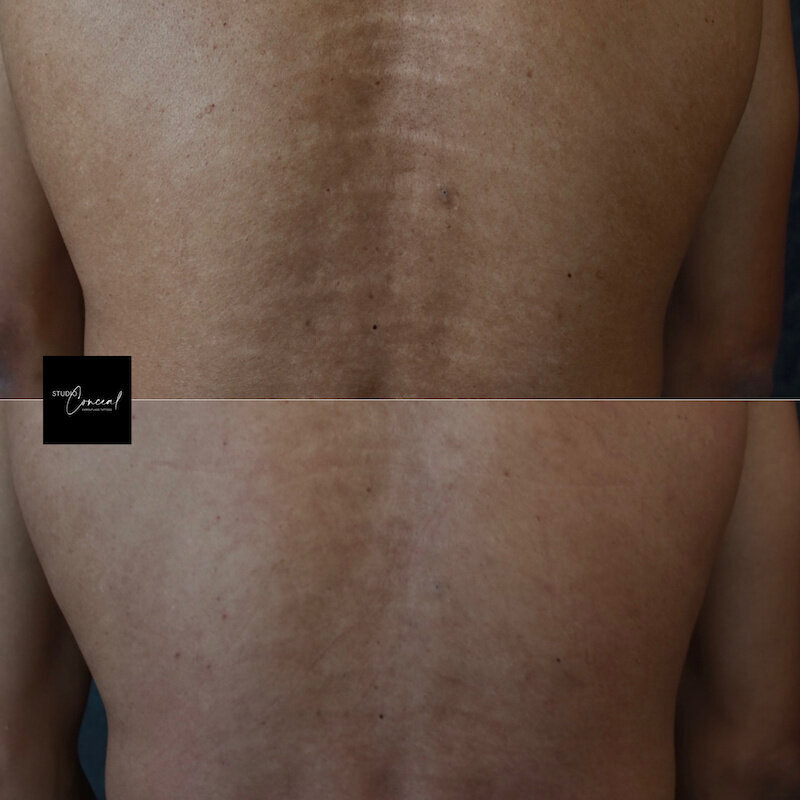 Male-stretch-marks-back-2