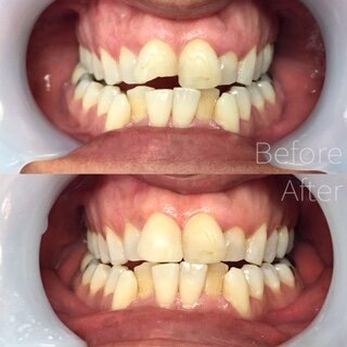 filling20on20an20upper20front20tooth20due20to20an20old20broken20filling.JPEG