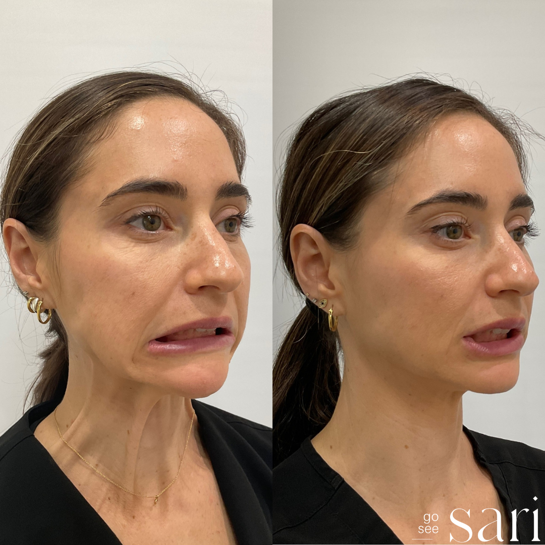 Neck Botox_Tatiana