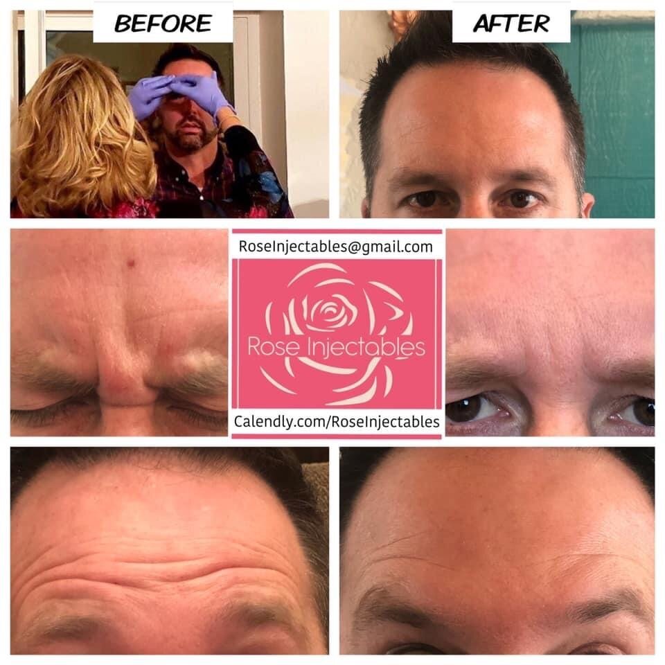 Botox-by-Rose-Injectables-Before-and-After-Photos-3