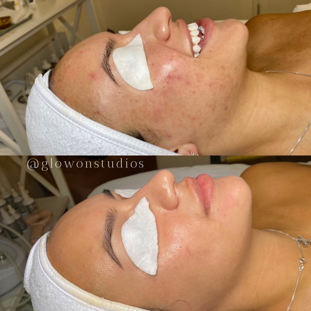 Glow-On-Studios-Before-After-Skincare-Sacramento-10