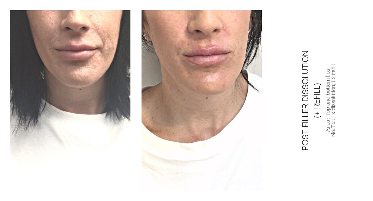 Filler Dissolve Before and After 1