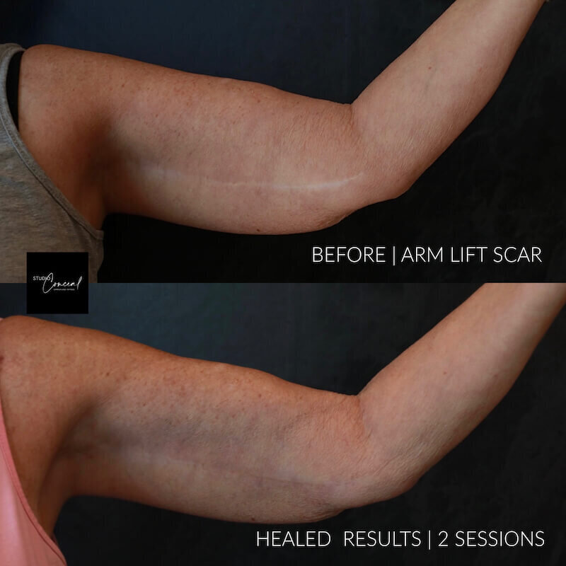 arm-lift-scar-camouflage (1)