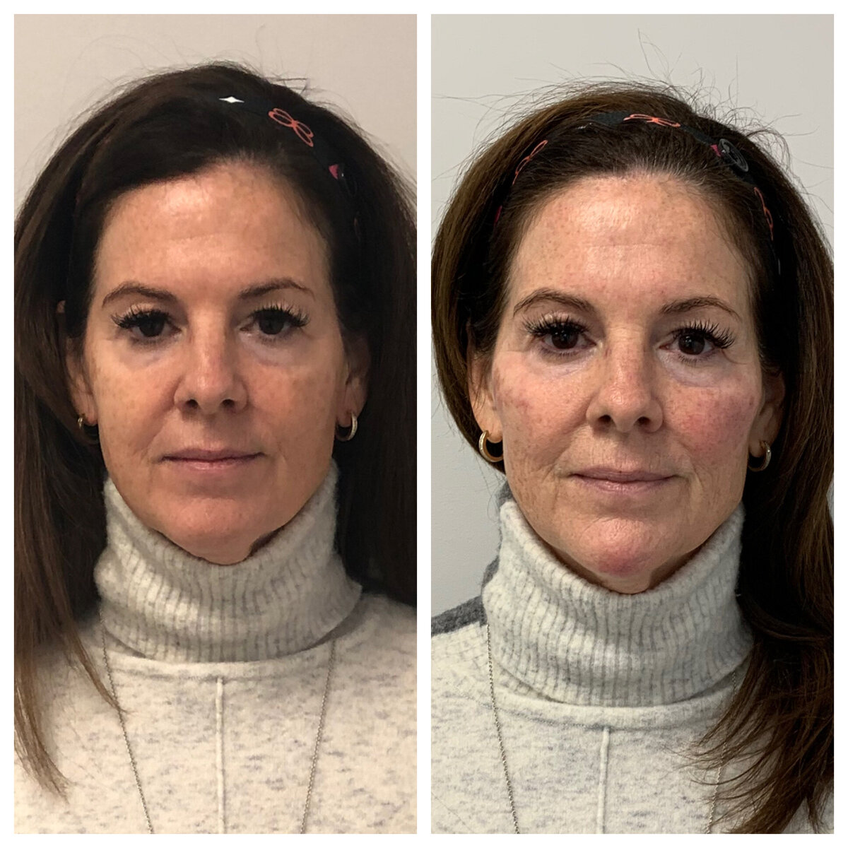 BalancedBeautyBotoxWestwood8