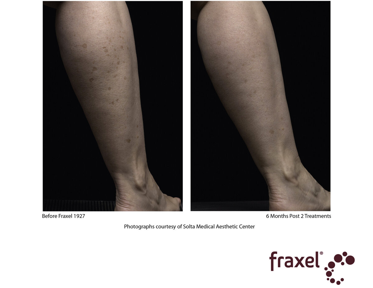 0301-Fraxel_1927_HiRes