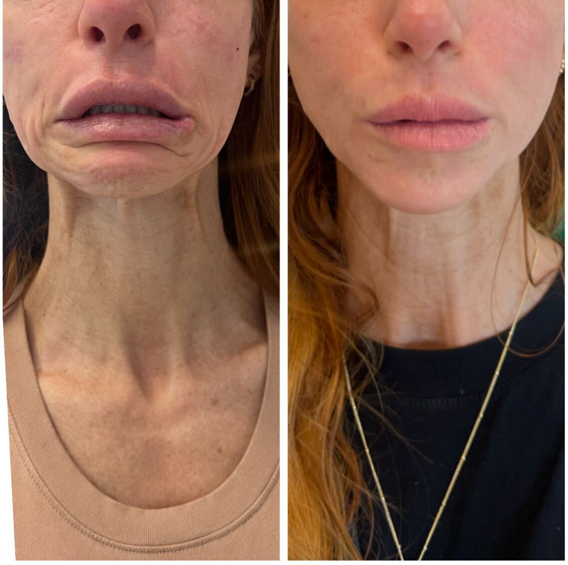 compressed-Neuromodulator-before-after-20