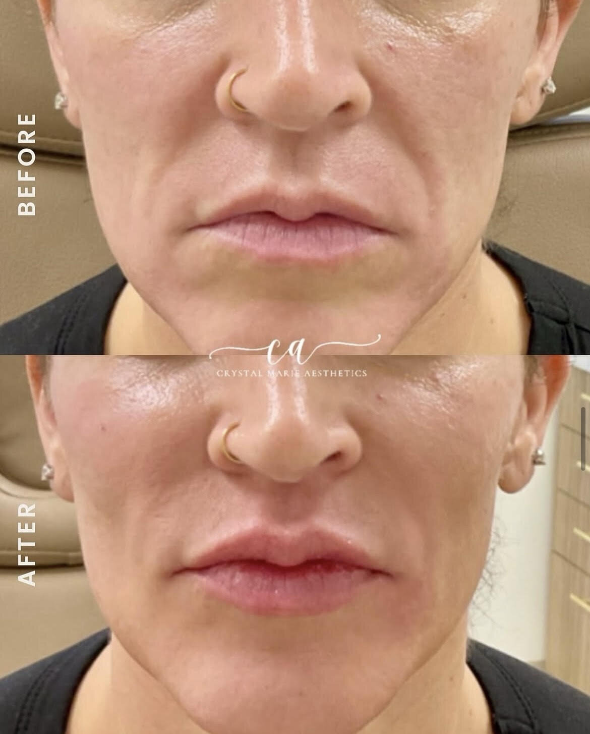 Nasolabial Folds Dermal Filler 