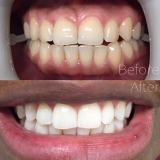 5bbd2ef8bdeff5295423a85b_before-after-10-zoom-whitening.JPEG