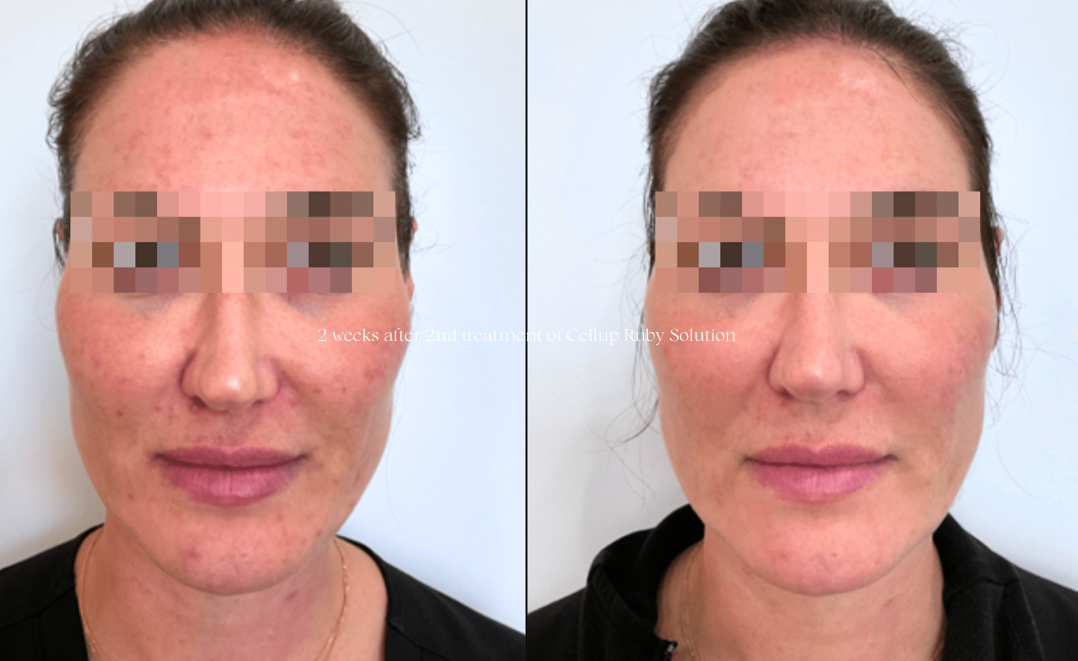 klaride-skin-booster-before-after-4
