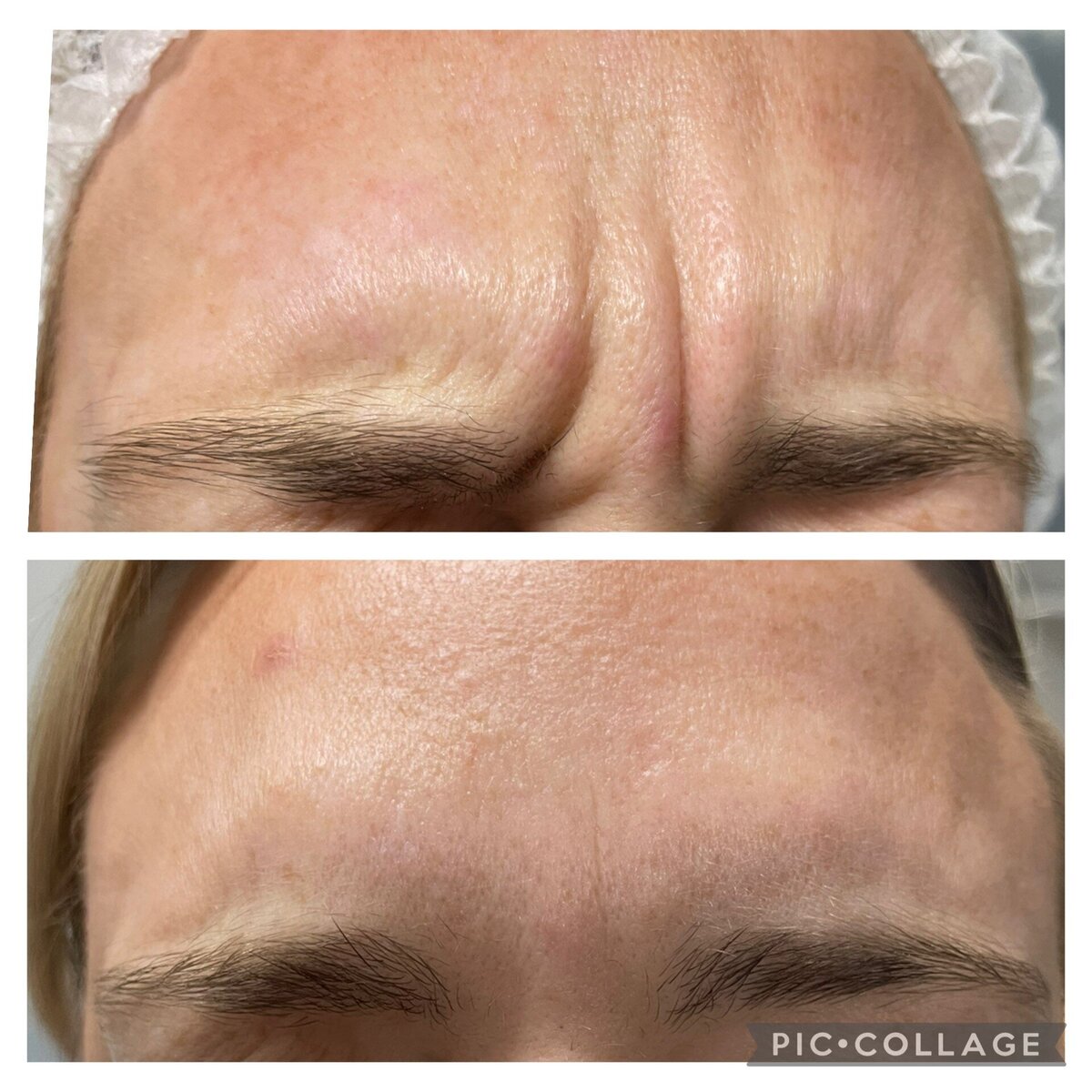 antiwrinkle injections in norwich based clinic aesthetic practitioner