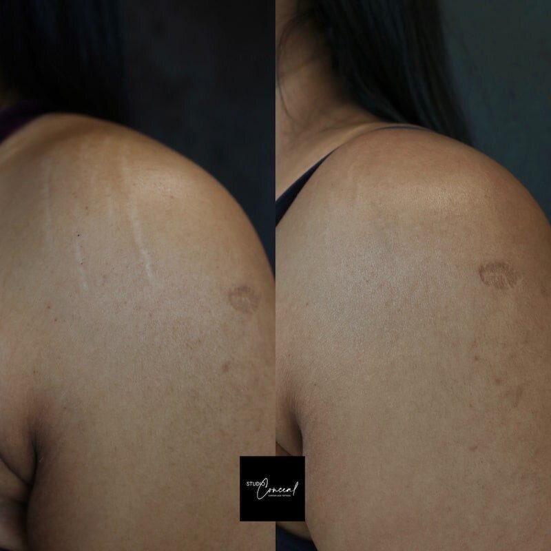 darker-skin-stretch-marks