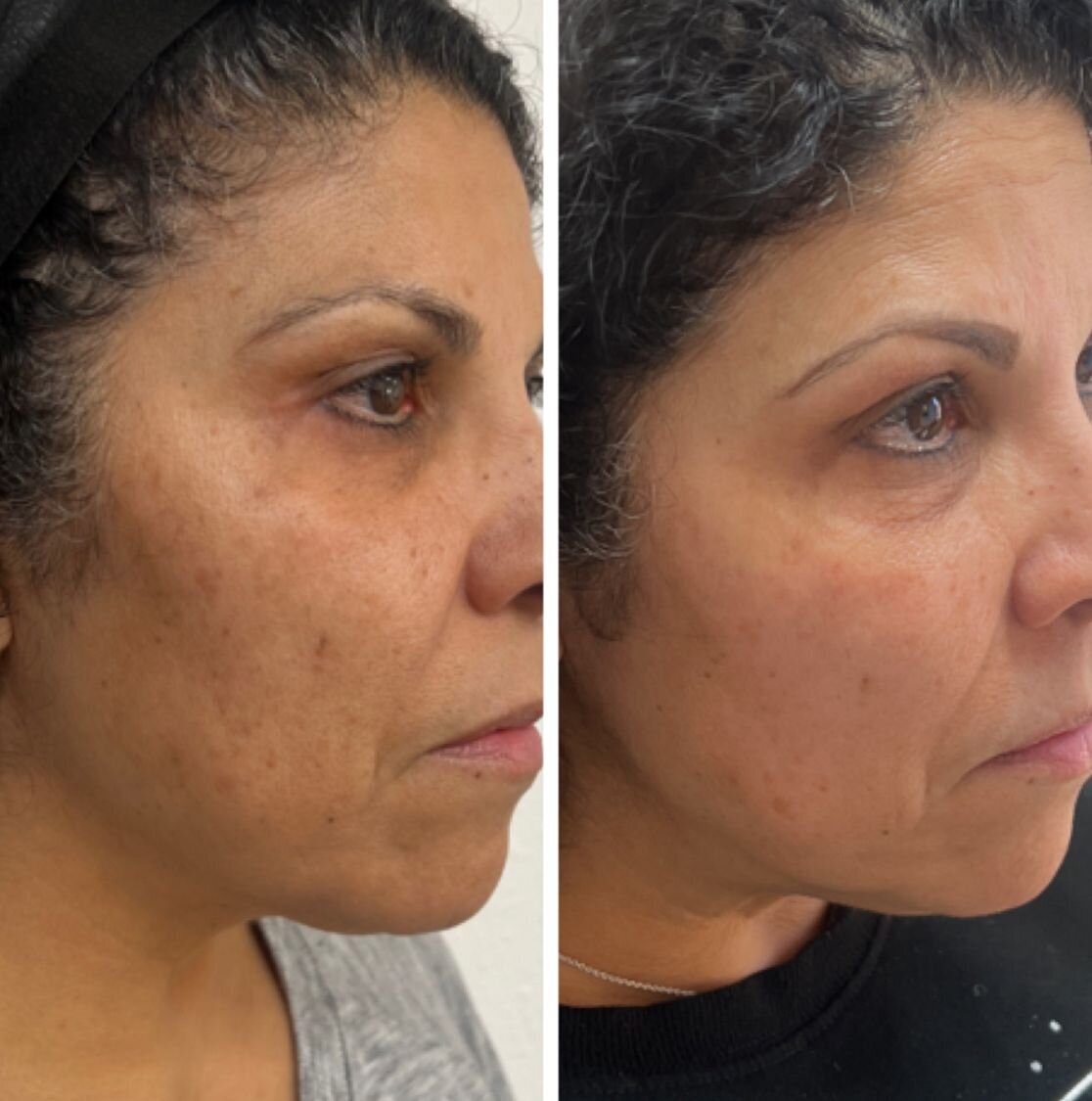 bbl-before-after-12