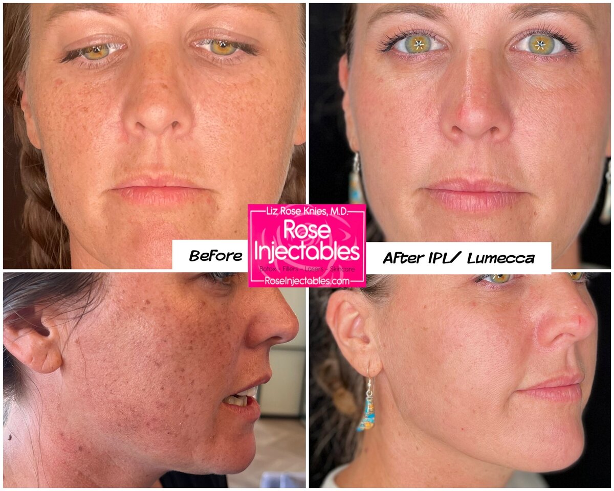 Lumecca-by-Rose-Injectables-Dark-Spot-Removal-Before-and-After-Photos-36