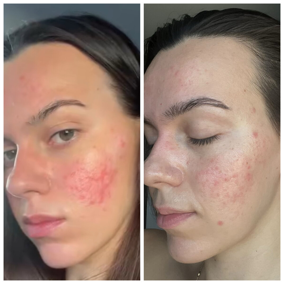 Holistic rosacea healing reducing redness and acne for healthier skin.
