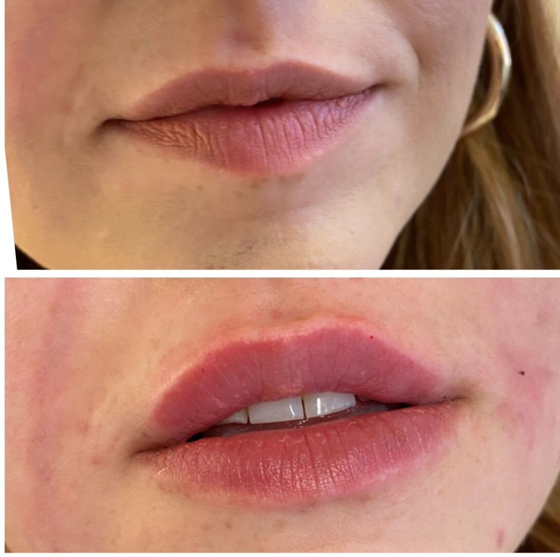 compressed-Lip-Wrinkles- Lip-volume-nd-some-brand-pics-09
