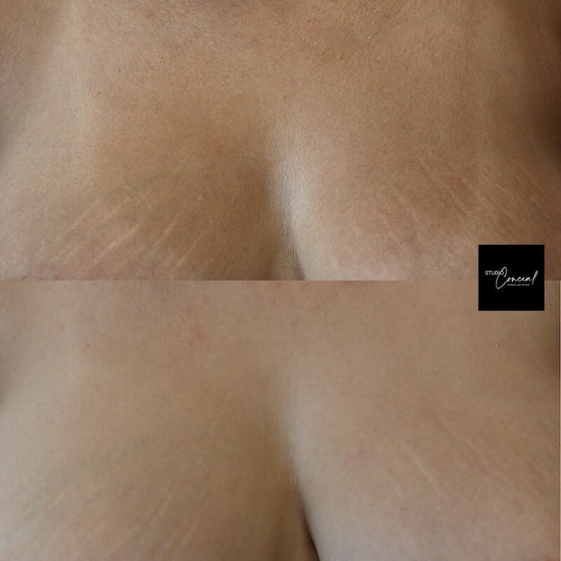 Breast-Stretch-Mark-Camouflage-2
