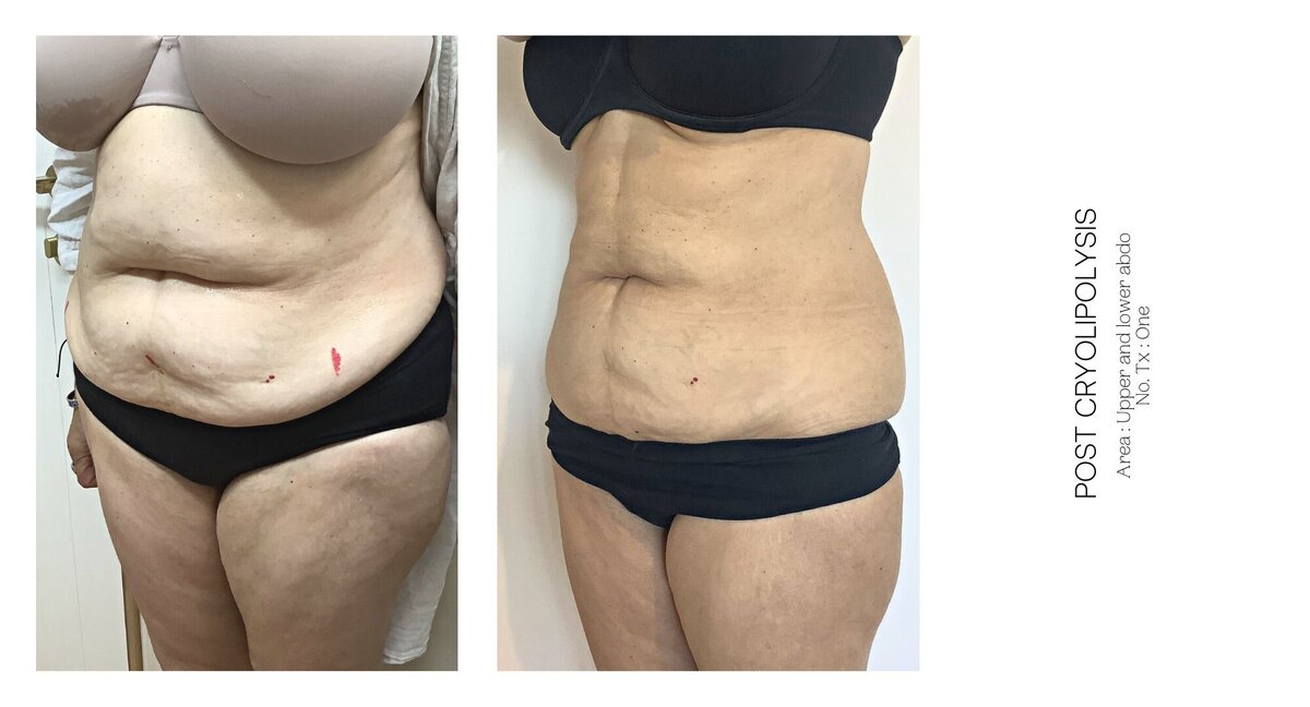 Cryolipolysis Stomach Before and After 4