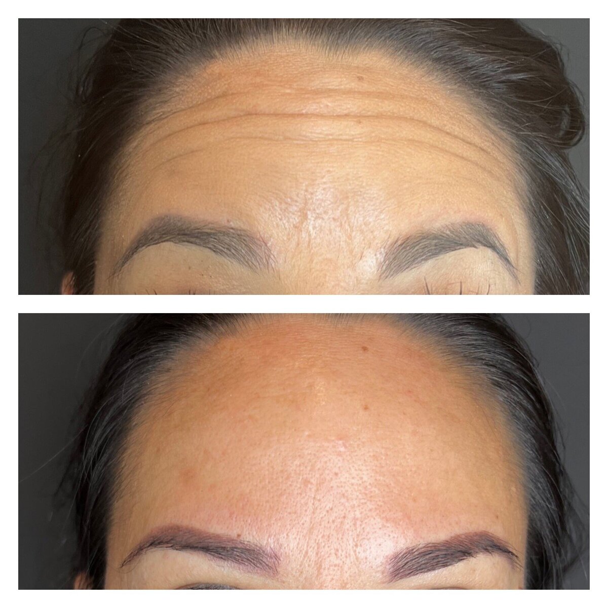 Botox Before and after