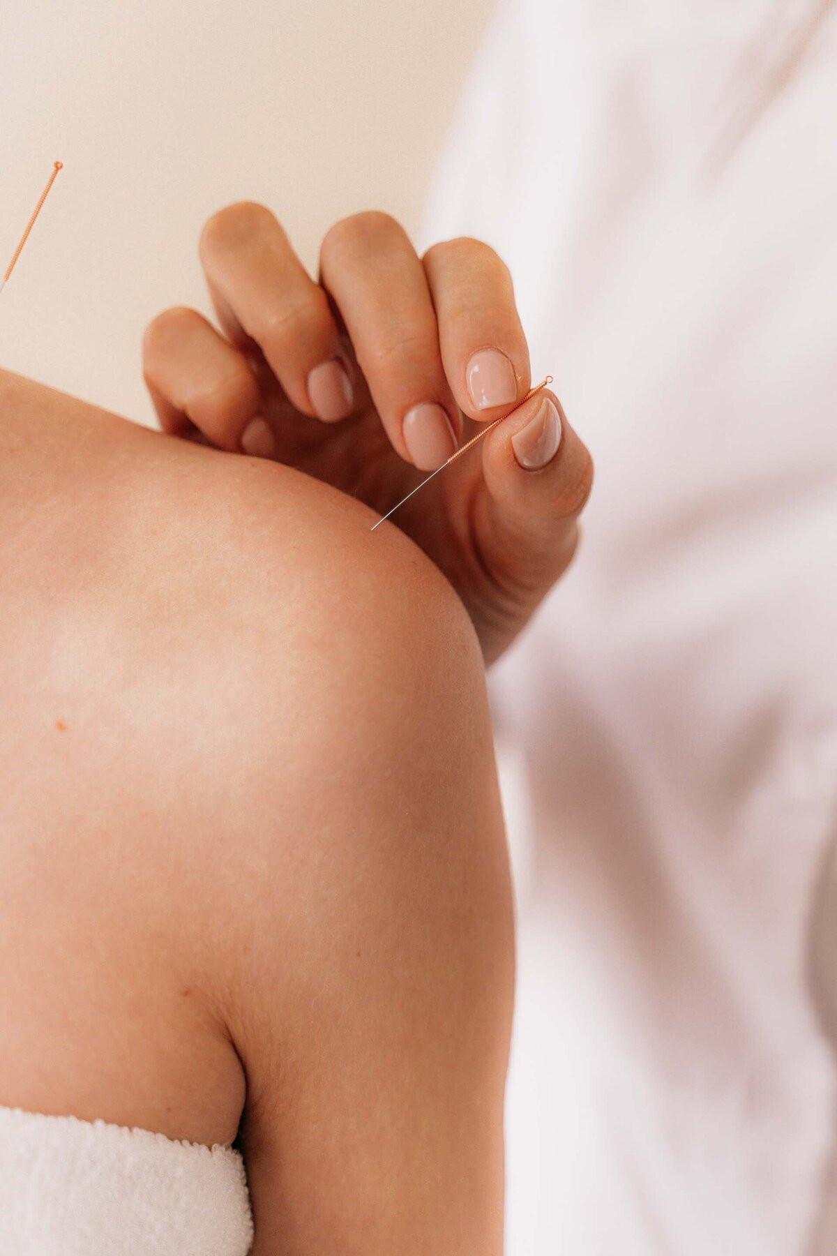 Acupuncture treatment in Fargo, ND