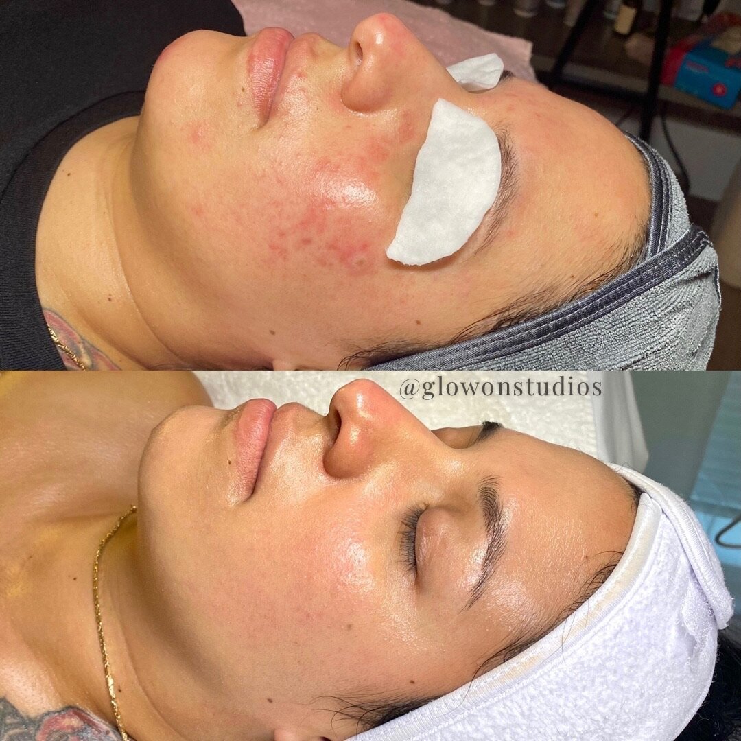 Glow-On-Studios-Before-After-Skincare-Sacramento-11