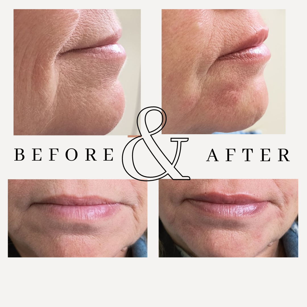 lip hydration and hallows