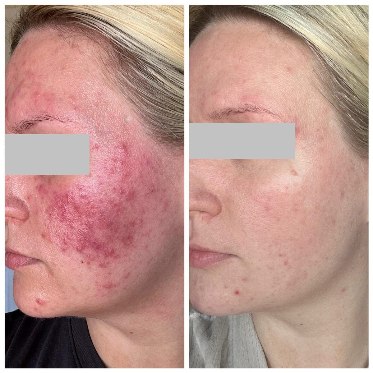 Dramatic improvement of extreme rosacea symptoms, including redness and inflammation, after following The Rosacea Method.