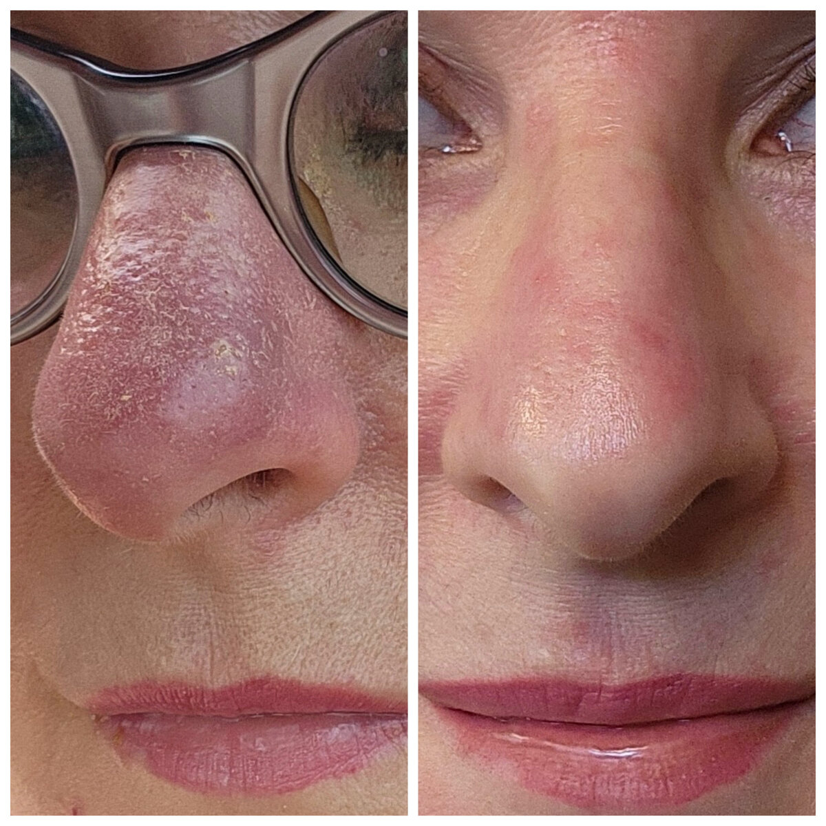 Before and after images of phymatous rosacea showing reduced nose redness and improved skin texture