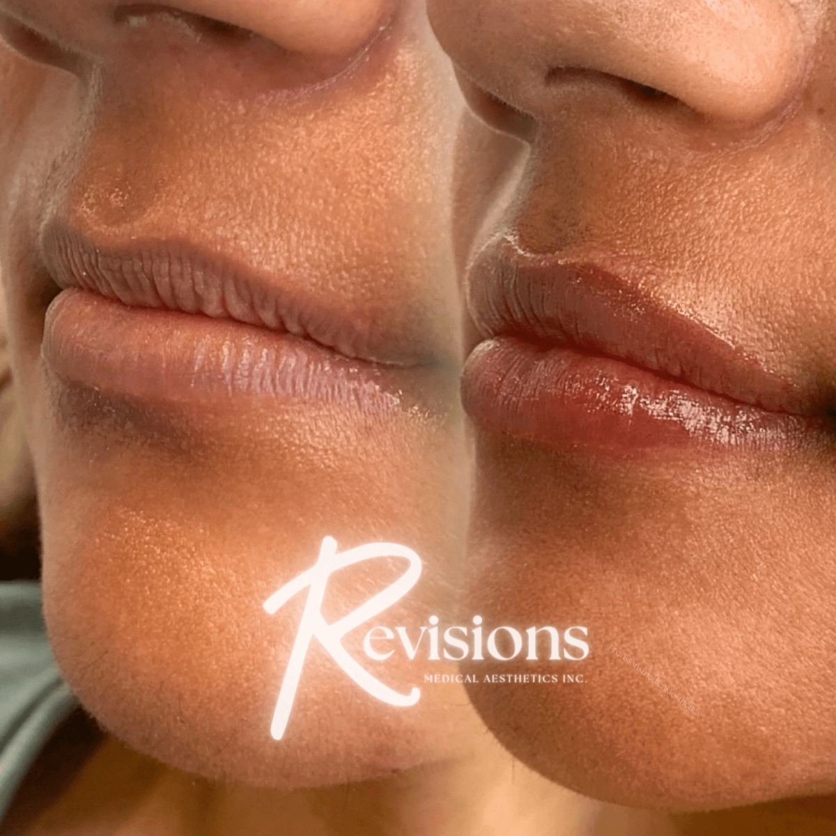 Nurse_Injector_Ottawa_for_Lip_Filler (1)