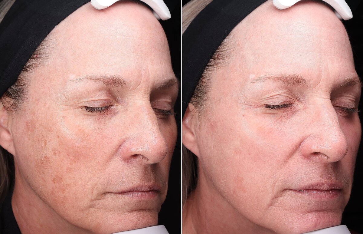 Allure AZ_Cosmelan peel results before and after Flagstaff AZ_0034