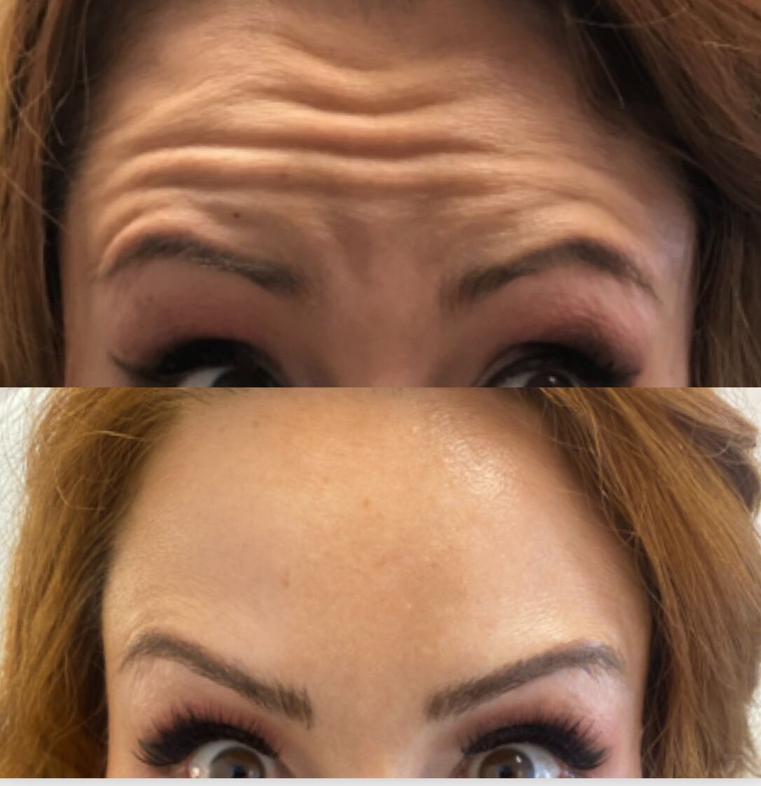 compressed-Neuromodulator-before-after-12