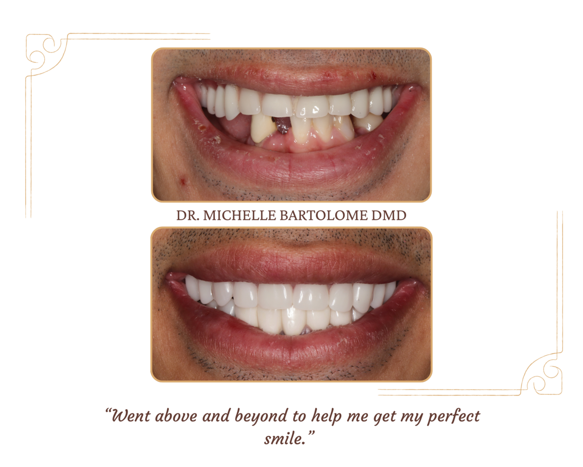 Replace Missing Teeth, Dentures