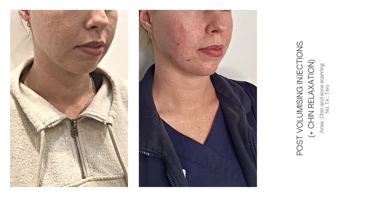 Chin Injections Before and After 2