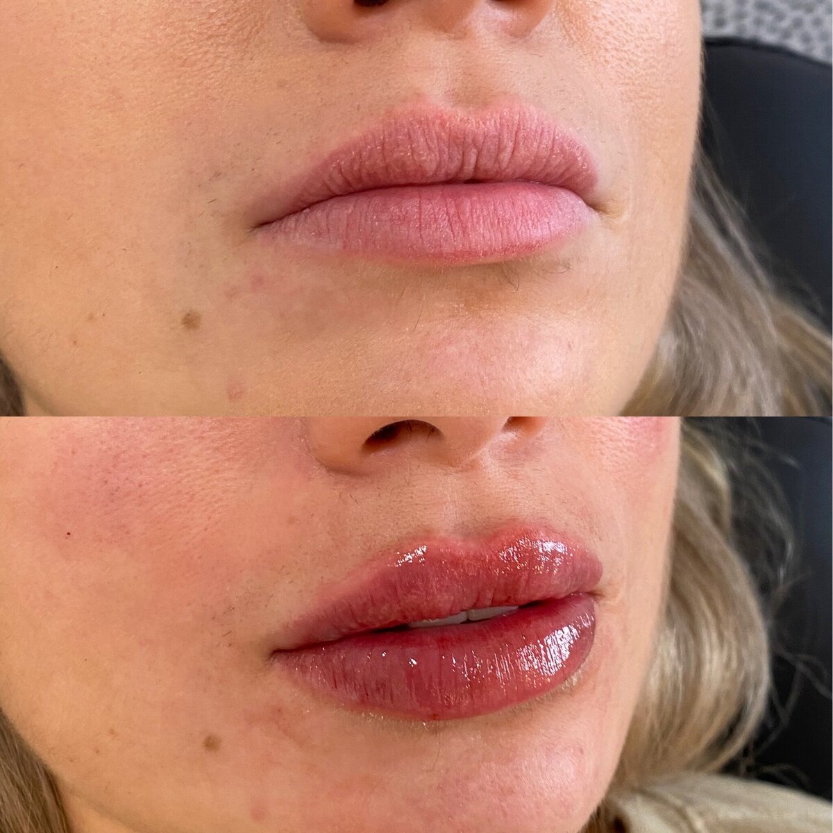 BalancedBeautyBotoxWestwood16