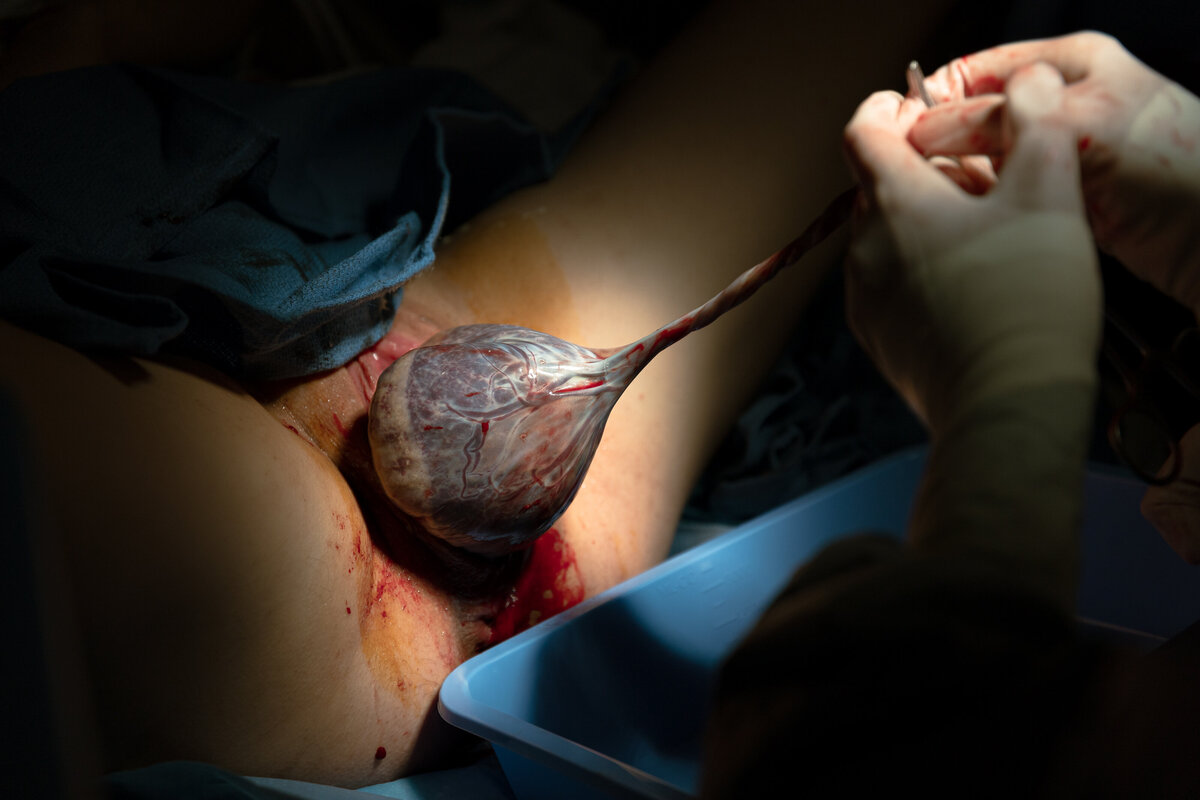 Doctor delivers the placenta after birth of baby