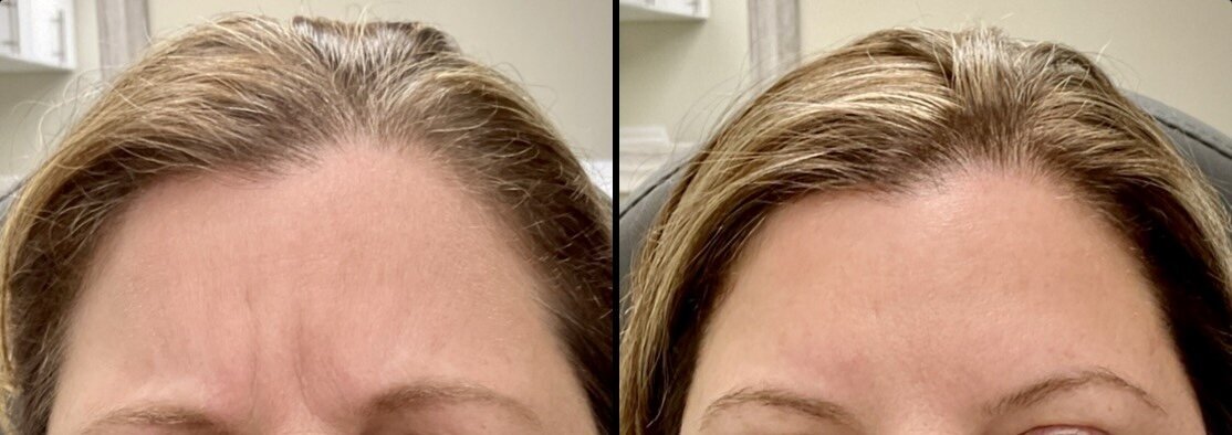 botox treatment to forehead and glabella
