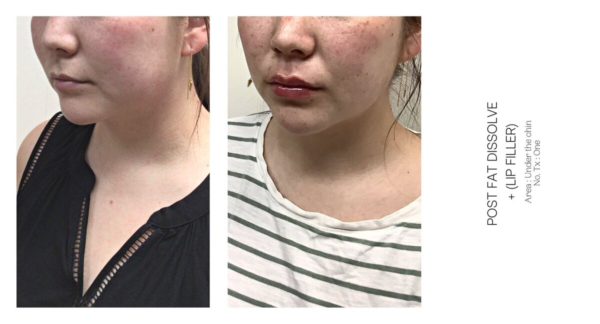 Under Chin Fat Dissolve Before and After 1