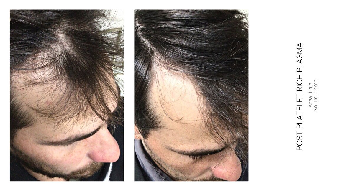 PRP Hair Before and After 2